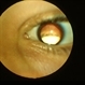 Choroidal coloboma Choroidal coloboma